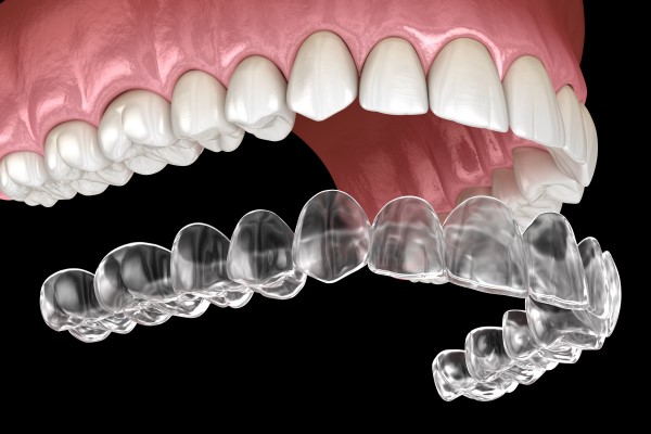 Invisalign aligners