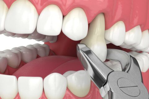 Pre Tooth Extraction Tooth Extraction in Patients Under Warfarin Therapy | The Healths Take
