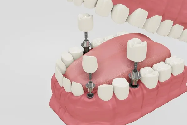 dental implants