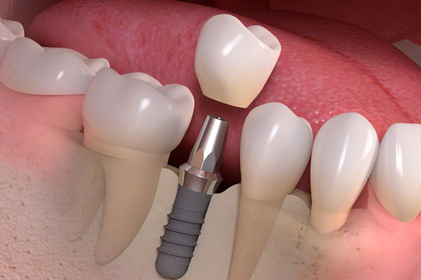 Dental Implant